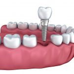 Do not ignore these tips before getting dental implants