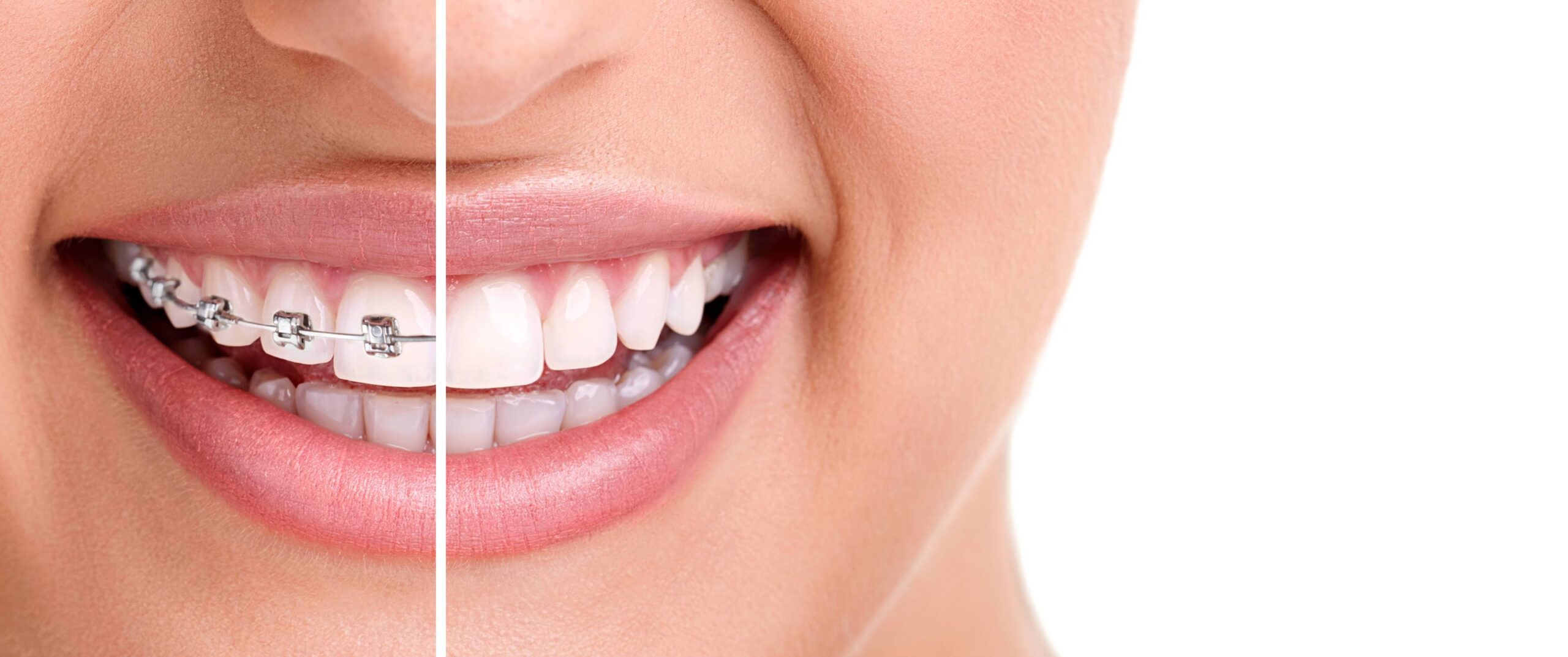 5 Tips For Improving The Results Of Your Orthodontic Treatment
